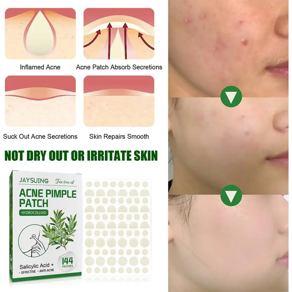 "144 Patches Hydrocolloid Acne Pimple Patches with Salicylic Acid & Tea Tree Oil – Fast Relief for Inflamed Acne & Whiteheads, Translucent Matte Finish for Discreet Healing!"