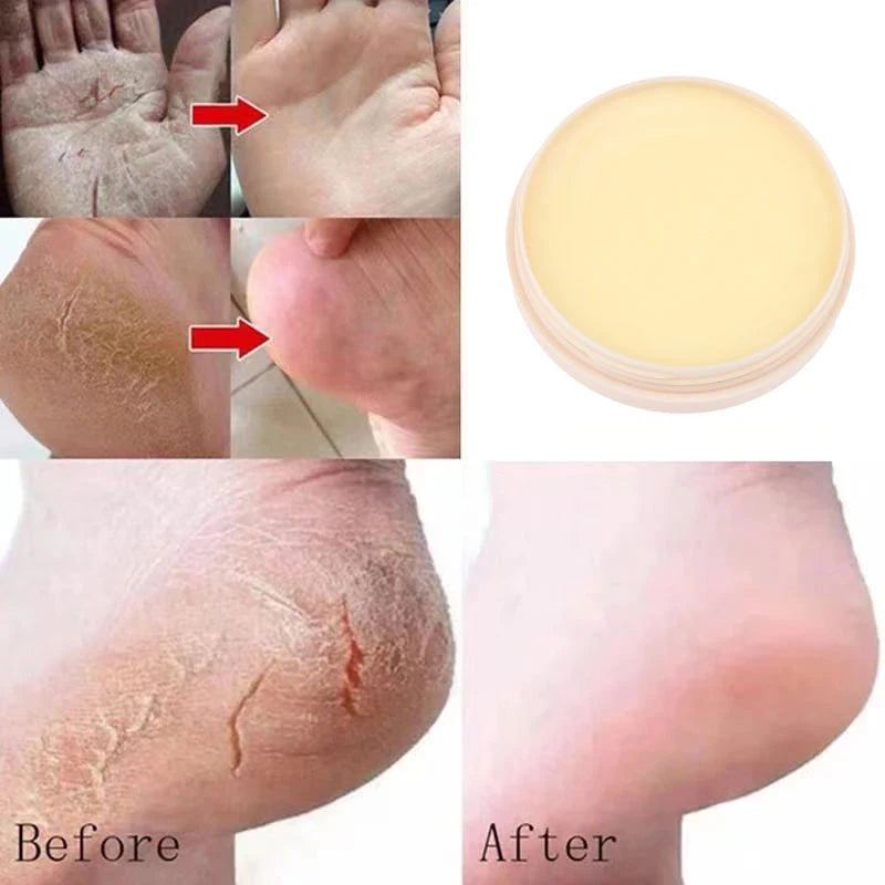 **Transform Your Feet with 20g Healing Foot Cream - Say Goodbye to Cracks and Hello to Silky Softness!**