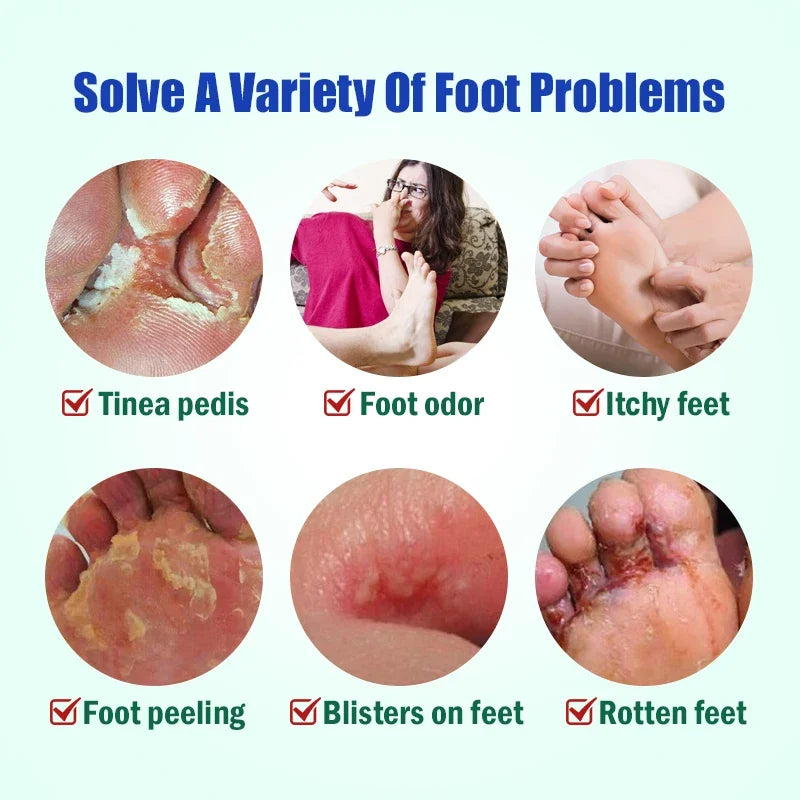 **Say Goodbye to Athlete's Foot: 5x Powerful Anti-Itch Treatment Creams - Effective Relief from Fungus & Peeling Skin!**