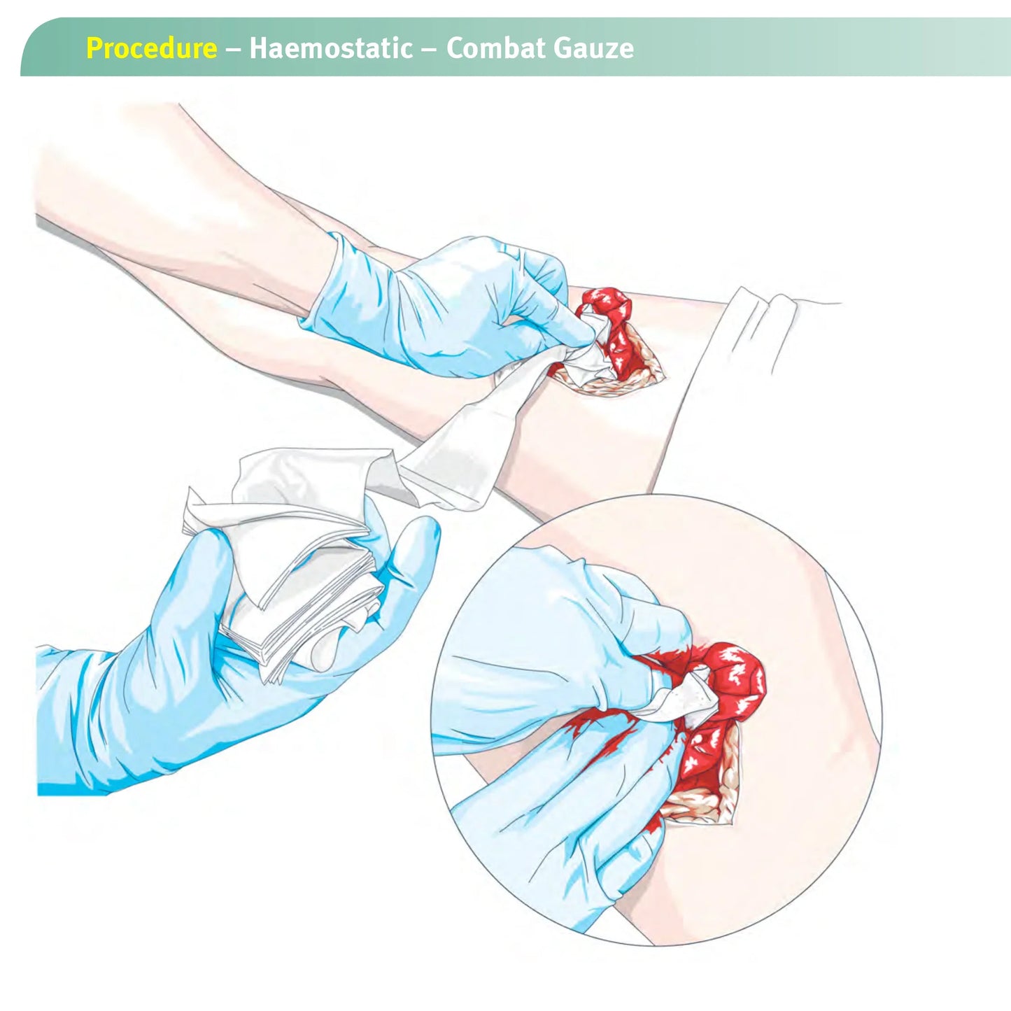 "Life-Saving High-Tech Kaolin Hemostatic Gauze - Z-Fold Combat Dressing for Rapid Response to Severe Organ  Bleeding | Essential Tactical Medical Gear for Adventurers"