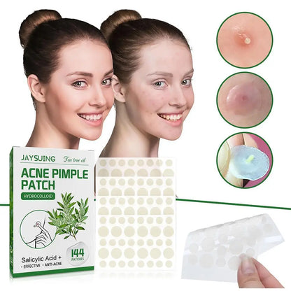 "144 Patches Hydrocolloid Acne Pimple Patches with Salicylic Acid & Tea Tree Oil – Fast Relief for Inflamed Acne & Whiteheads, Translucent Matte Finish for Discreet Healing!"