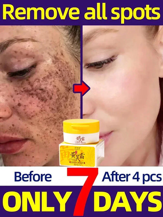 **Revitalize Your Complexion: Astragalus Whitening Cream for Freckles & Dark Spots – Embrace Radiance, Fight Aging & Unveil Flawless Skin Naturally!**