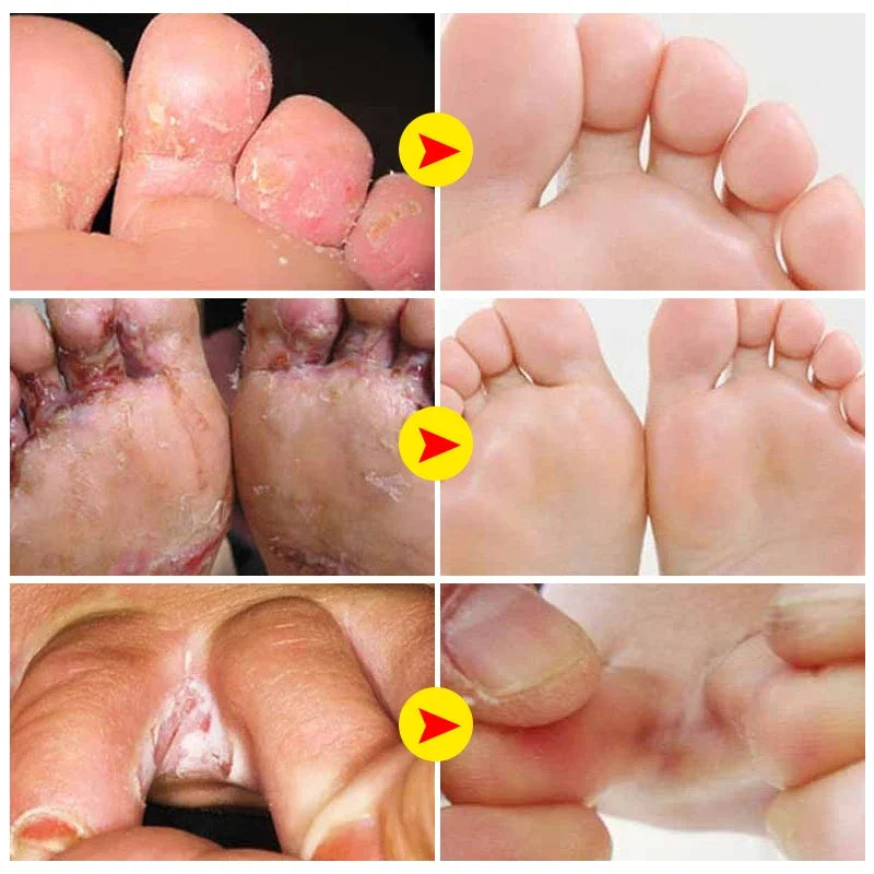 **Say Goodbye to Athlete's Foot: 5x Powerful Anti-Itch Treatment Creams - Effective Relief from Fungus & Peeling Skin!**