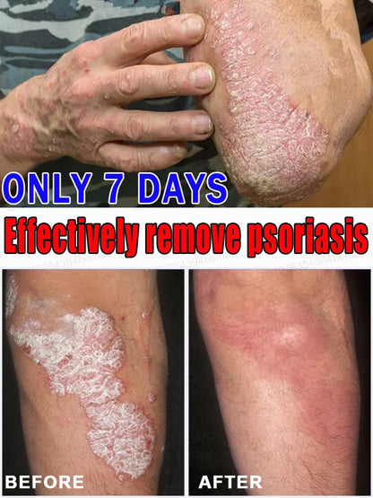 "Say Goodbye to Itchiness! Powerful Antipruritus Cream for Dry Skin – Moisturizing Relief for Prickly Heat & Irritated Areas | Feel the Difference!"